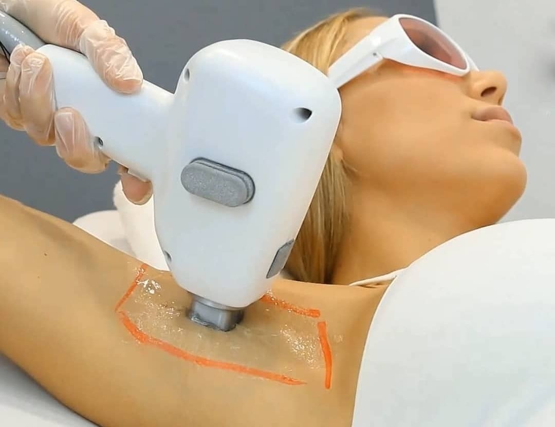 LASER DIODO PUBIS COMPLETO