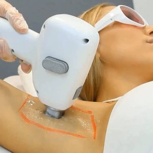 LASER DIODO ESPALDA COMPLETA + HOMBROS